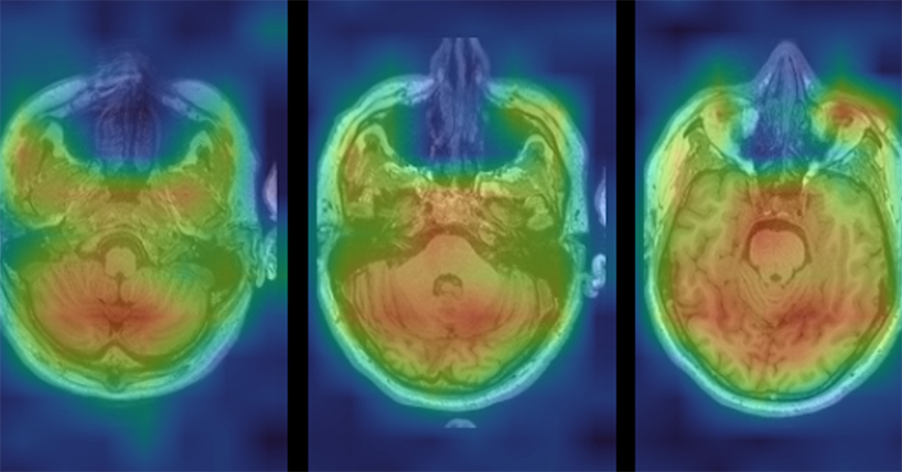 A brain scan with red, yellow, green shading showing the intensity of distribution of lithium in patients with bipolar disorder